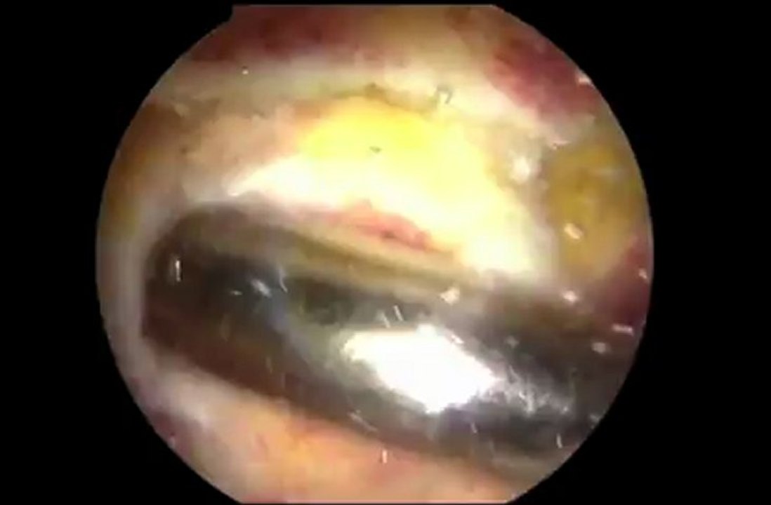 resection AC