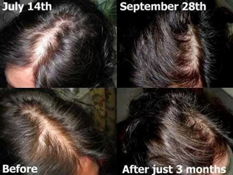 Treatment for Hair Loss : How to Regrow Your Hair Easily and Naturally