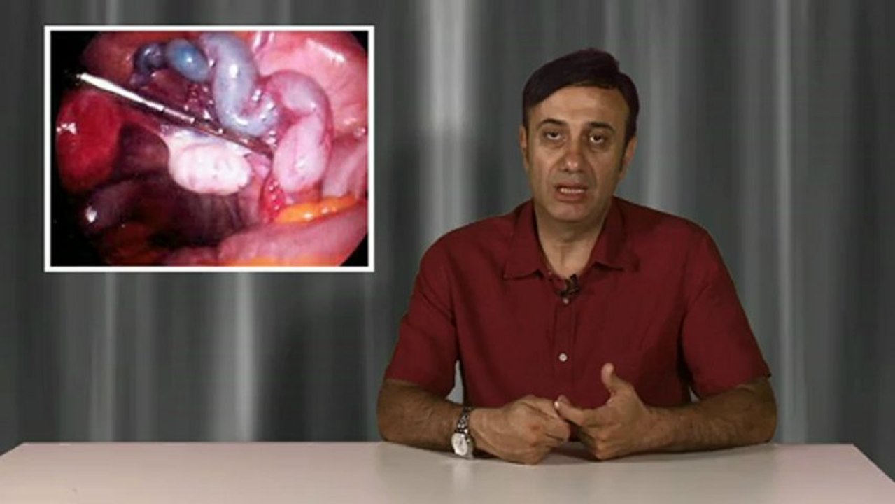 Hidrosalpinks (içi sıvı dolu tüp veya kanal) tüp bebek tedavisini nasıl etkiler? Tedavide uygulanan salpinjektomi (tüplerin alınması ameliyatı) ameliyatı tedaviyi nasıl etkiler?