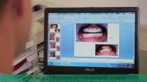 Refaire toutes ses dents avec implants