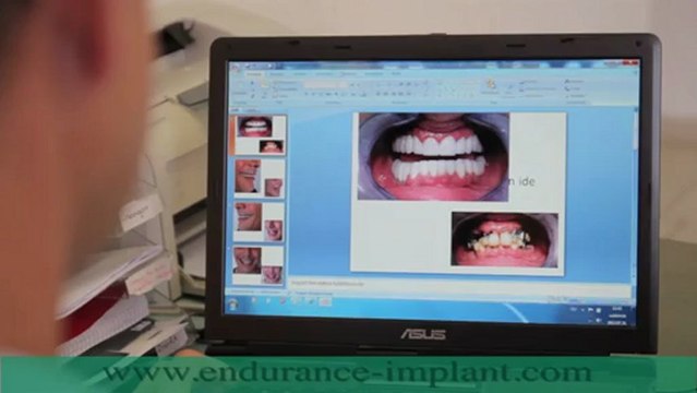 Refaire toutes ses dents avec implants