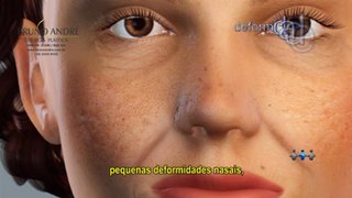 Preenchimento e aumento de lábios - Dr. Bruno C. André