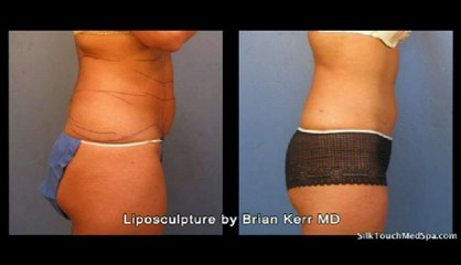 Silk Touch Medspa Liposuction abdomen area 2
