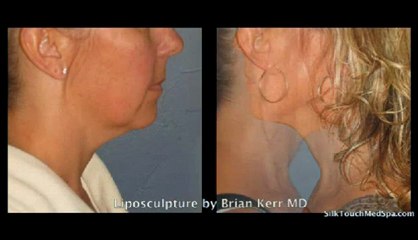 Silk Touch Medspa Liposuction Neck area
