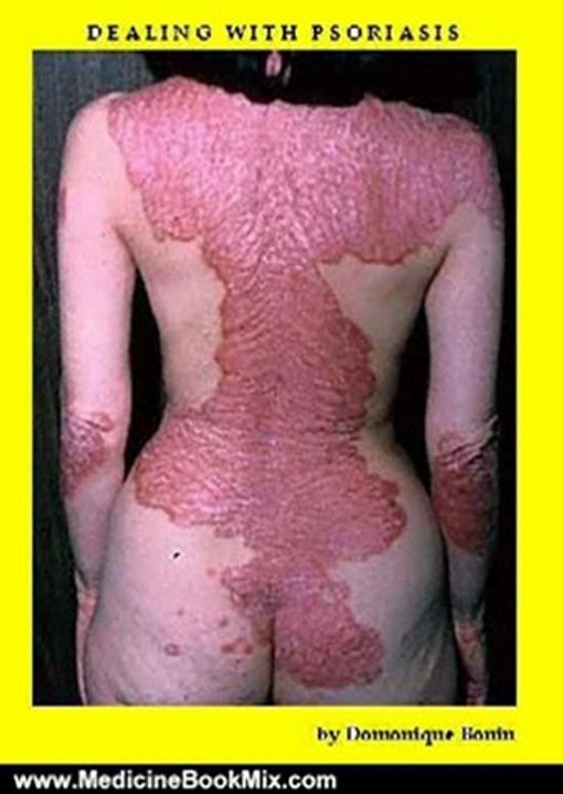 Medicine Book Review: Dealing with Psoriasis by Domonique Bonin