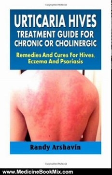 Medicine Book Review: Urticaria Hives : Treatment Guide For Chronic Or Cholinergic: Remedies And Cures For Hives, Eczema And Psoriasis by Randy Arshavin
