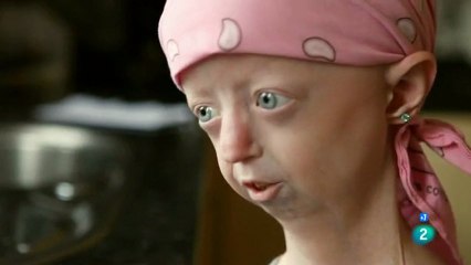 Progeria: Una adolescente de 105 años (Hayley)
