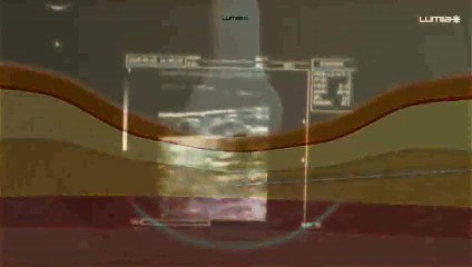 ECOLIPOLÁSER: LA EVOLUCIÓN DE LA LIPOESCULTURA LÁSER – DR. CARLOS RAMOS