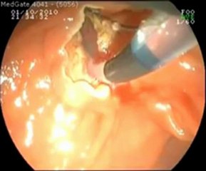 ERCP Sfinkteretomi (Prof. Dr. Kayıhan Günay)