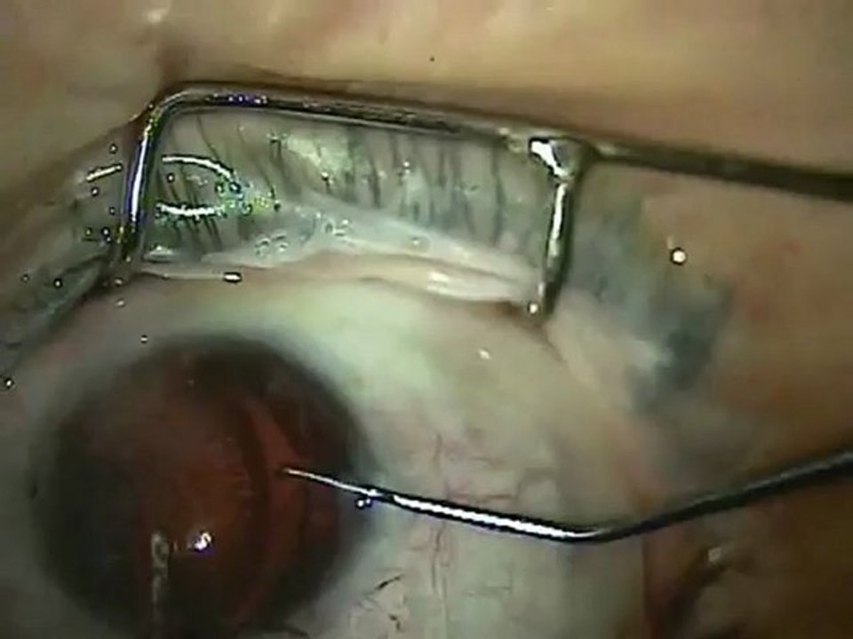Iris medical implant brightocular surgery