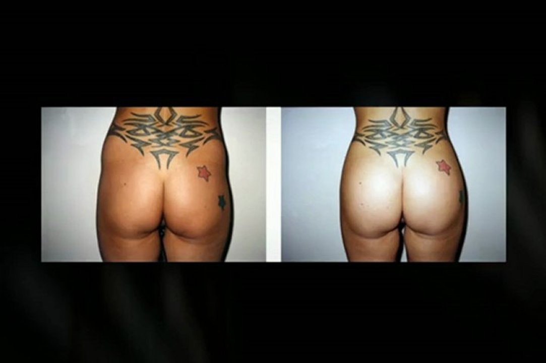 Brazilian Butt Lift NYC - Plastic Surgeon