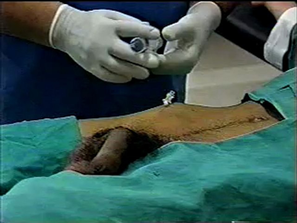 ILEOINGUINAL