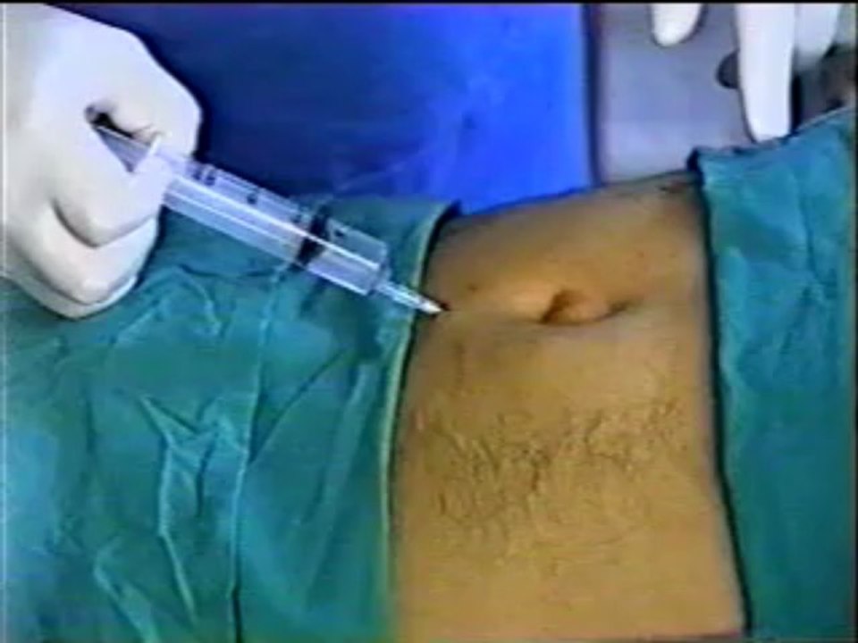 PERIUMBILICAL