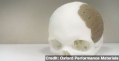 75% of Man's Skull Replaced by 3D-Printed Implant