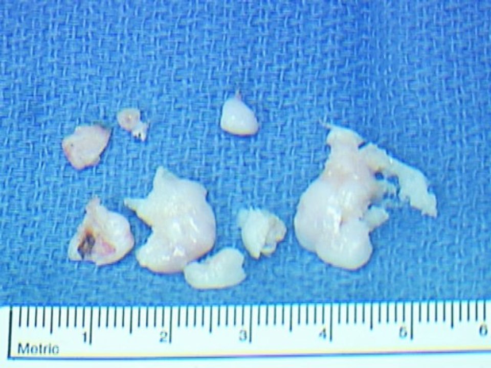 Dr Bruce E Ellison MD - Orthopedic Surgery Near Sequoia Hospital El Camino Hospital - Expert Witness AME IME San Francisco Bay Area - Knee Arthroscopy for Internal Derangement Meniscal Tear