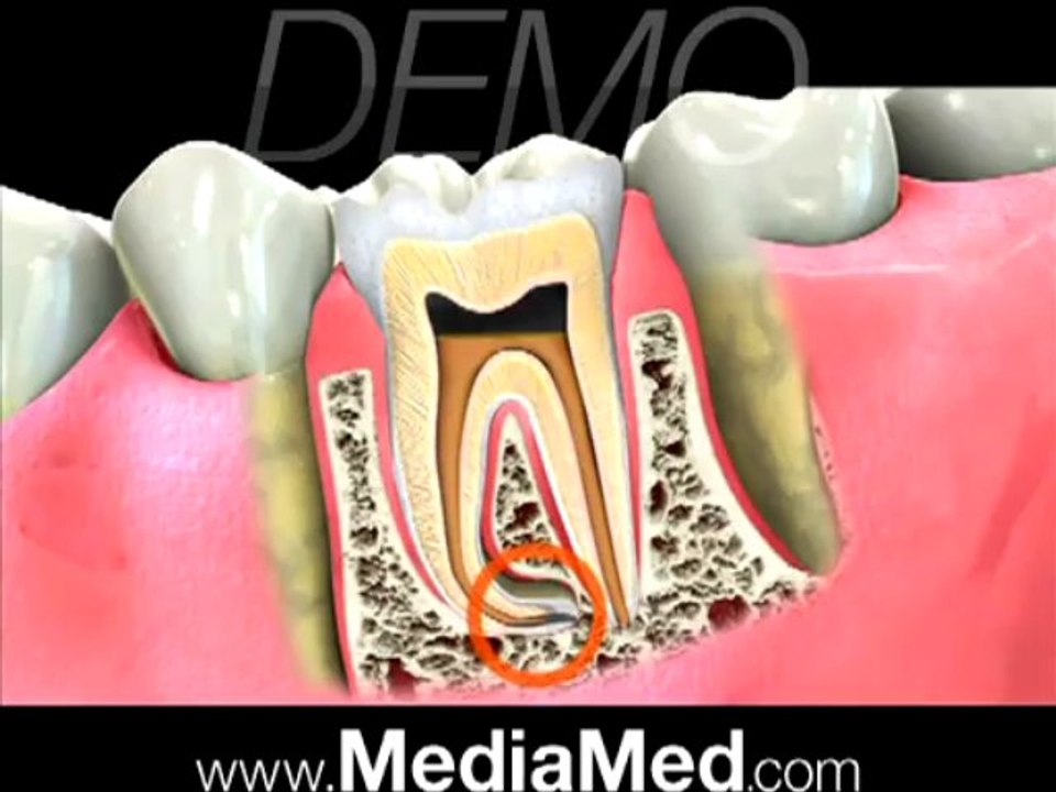 Dr Tarik Farooq- Dental Root Canal