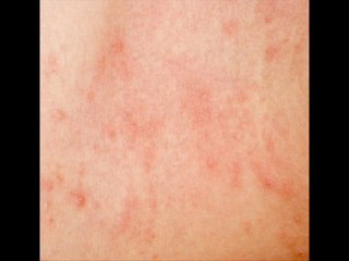 Shingles Treatment Tricks
