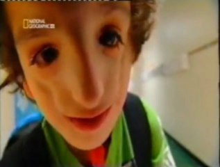 Sindrome de Treacher-Collins: Nathaniel (Deformidad craneofacial)