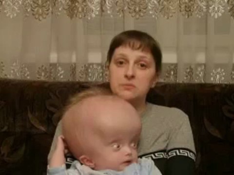 Enfant Hydrocéphale en Ukraine