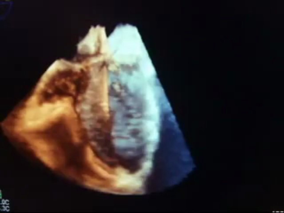TEE 3D four cardiac chambers view
