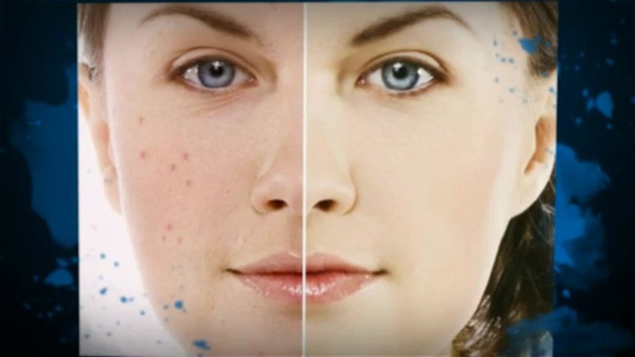 Como Evitar Las Espinillas - Para El Tratamiento Eficaz De La Piel