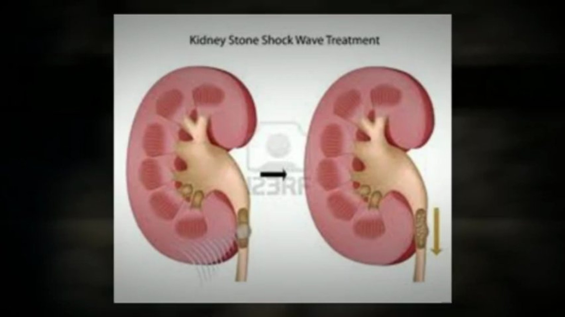 ⁣calculos renales tratamiento - Información sobre el tratamiento natural de los cálculos renales