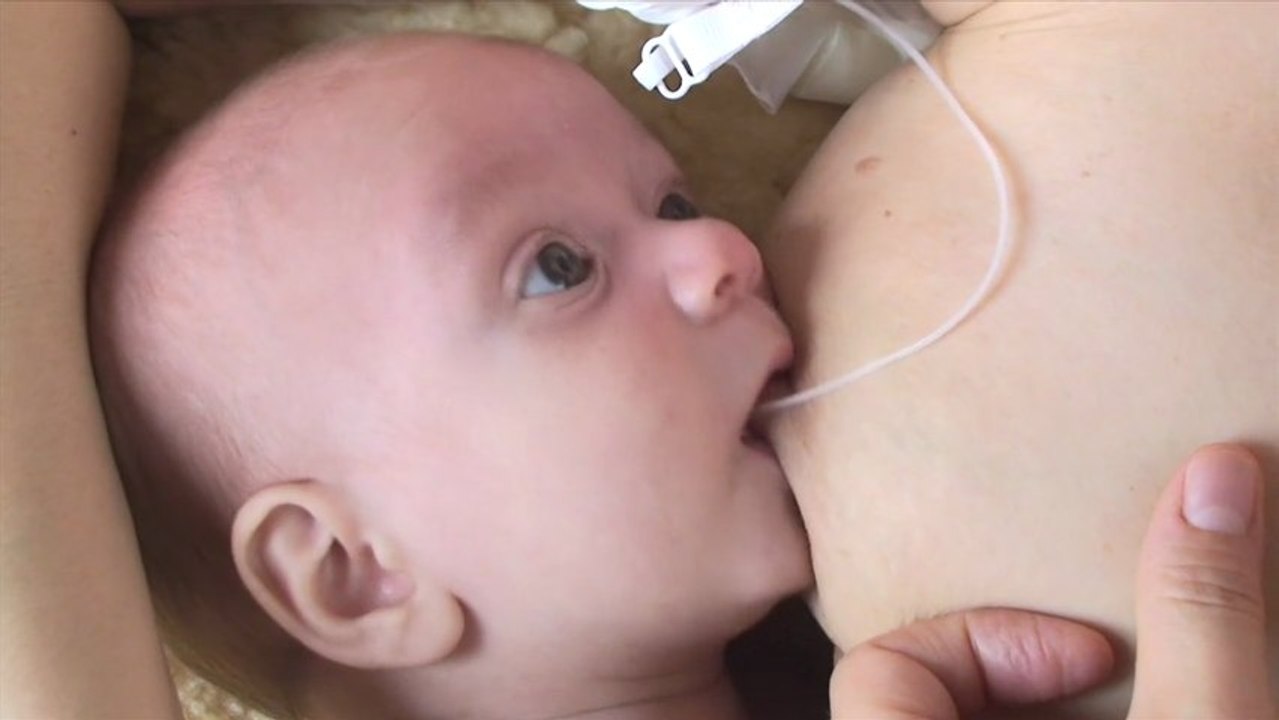 DAL pour un bébé présentant une succion désorganisée