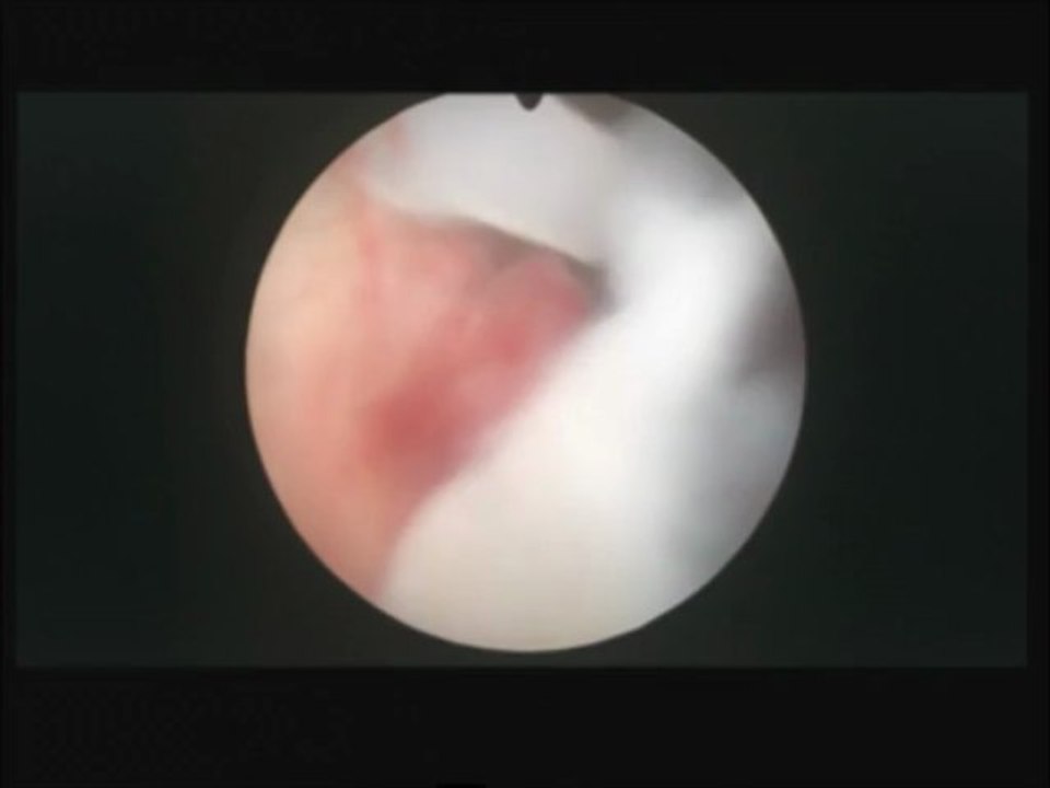 İpi kopmuş rahim içi araçın (kayıp spiral, kayıp ria) histeroskopik yöntem ile rahimden alınması