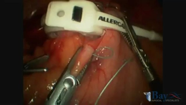 Bariatric Surgery - Actual Lap Band Surgery Procedure