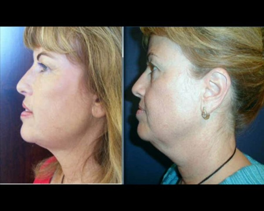 ד"ר אבישי וינברגר - תמונות לפני ואחרי טיפולי הצערת פנים,הזרקת שומן,מילוי שפתיים ועוד..