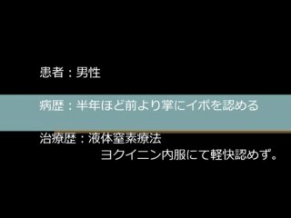 ウィルス性イボ注射療法（手）