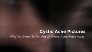 Cystic Acne Pictures - OMG I Should Consult A Dermatologist
