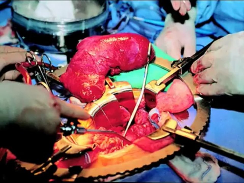 Organ Nakli - Tarih