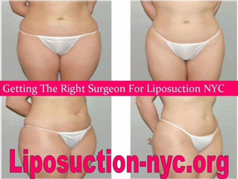 Best Liposuction Procedure