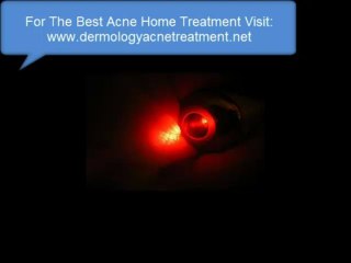 acne home treatment - home treatment