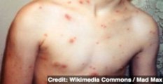 CDC Urges Chickenpox Vaccines Citing 15-Year-Old's Death
