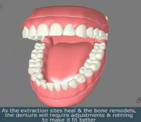 Dental Implant Restoration