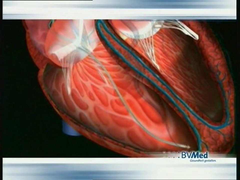 Kardio: schrittmacher medizintechnologie