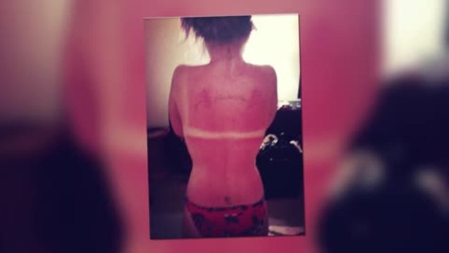 Bikini-Clad Kelly Osbourne Reveals Sunburn Marks
