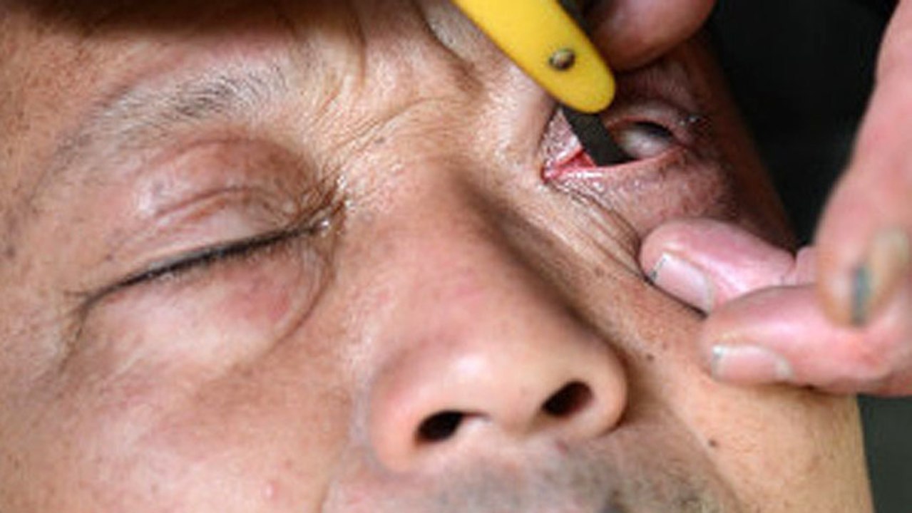 Eyeball Shaving In China