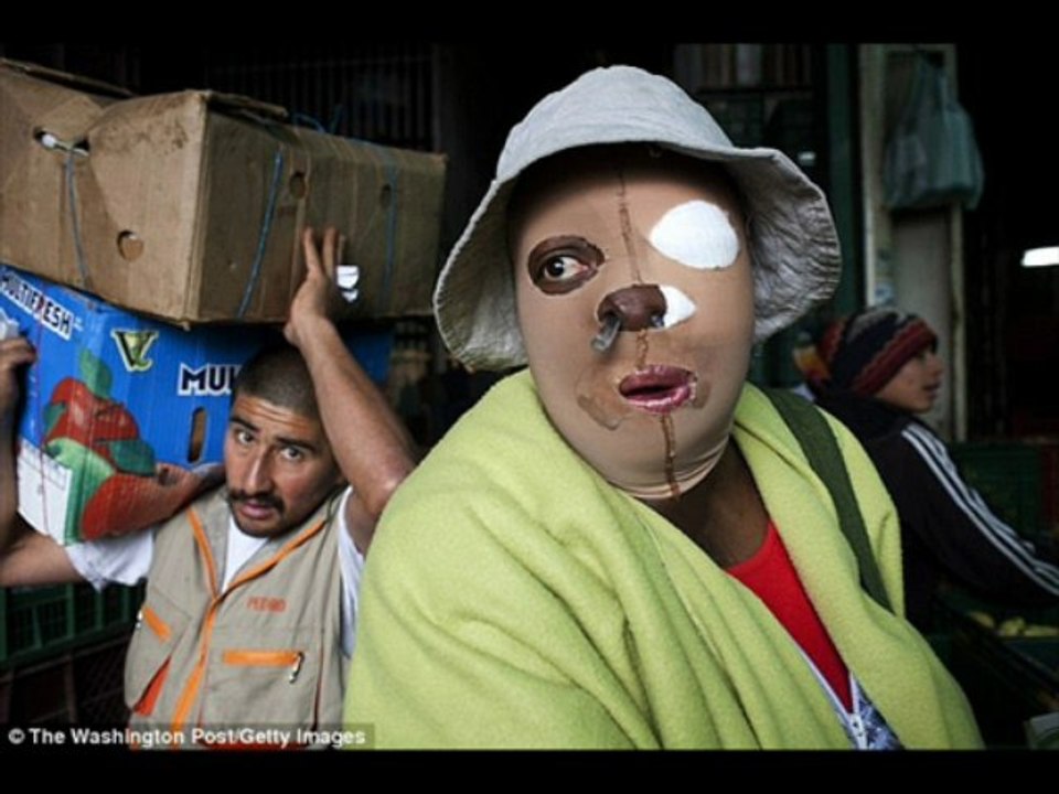 ACID VICTIMS