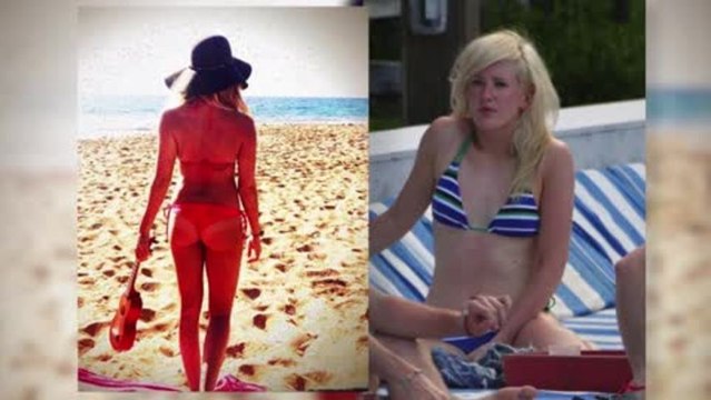 Les coups de soleil des stars