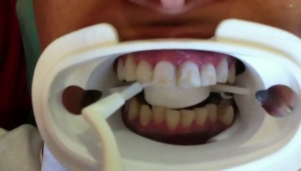 Veneers set up with Prophy Smile S
