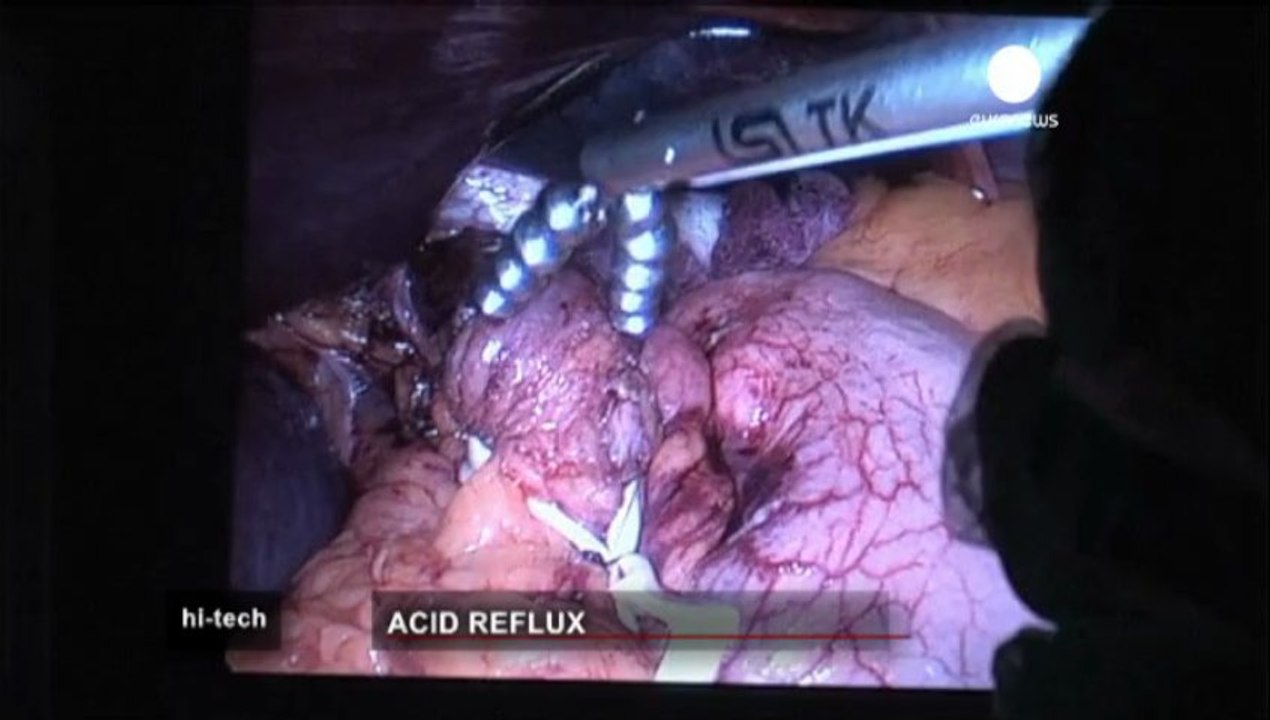 Internal bracelet cures acid reflux