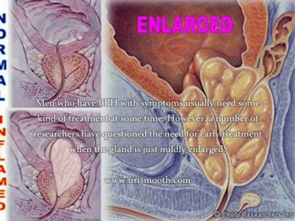 Naturopathic treatment for prostate enlargement?