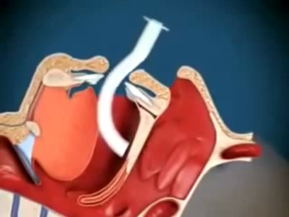 Colocacion de cânula orofarígea (cânula de Guedel)