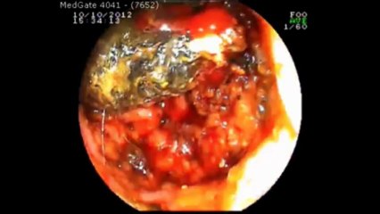 Bouveret Sendromu Ameliyatı - Mustafa Kayıhan Günay