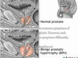 Drugs for Benign Prostatic Hyperplasia?