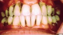 Bleeding Gums Could Be A Dental Warning Sign - OraMD