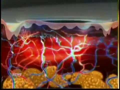 Body Contouring, Patients Ask for Alma Lasers